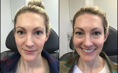 Before and After: Real Results from Oceanside Medical’s Botox and Dysport Services