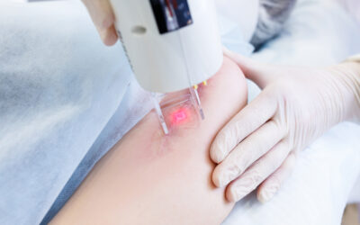 Laser Treatment: What It Is, How It Works, and When to Get It