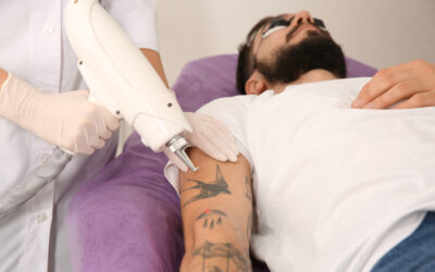 Laser Treatments for Tattoo Removal: How They Work and What to Expect
